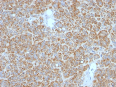 FFPE human melanoma sections stained with 100 ul anti-Bcl-2 (clone BCL2/782 + BCL2/796) at 1:50. HIER epitope retrieval prior to staining was performed in 10mM Tris 1mM EDTA, pH 9.0.